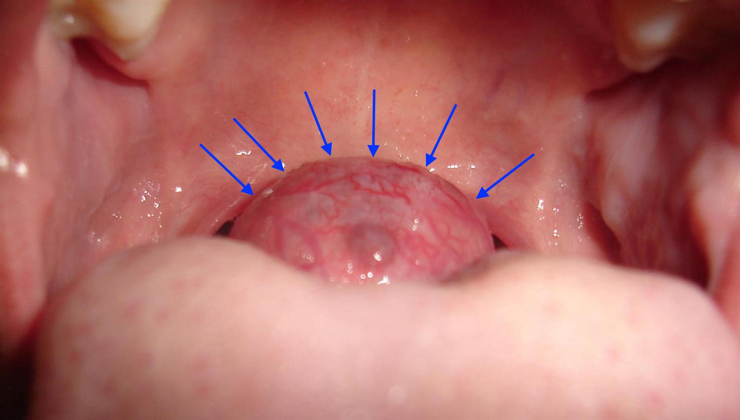 Και αυτός είναι ένας έκτοπος Γλωσσικός Θυρεοειδής στην βάση της γλώσσας.